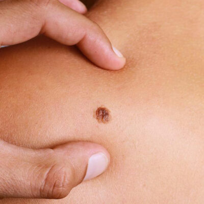 4 common types of melanoma and their treatment options