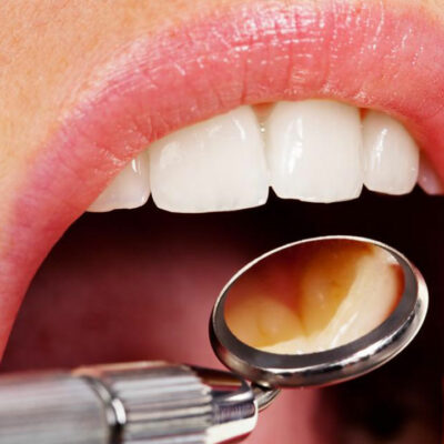 4 myths about dental implants busted