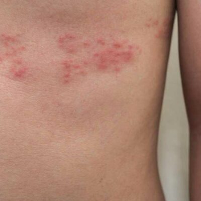 5 Ways to Deal with Shingles Nerve Pain