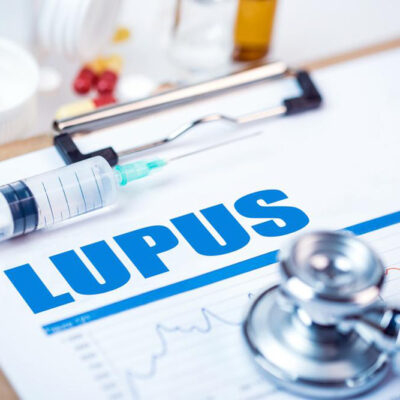 5 things to know about Lupus