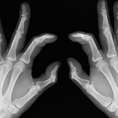 Early signs of rheumatoid arthritis and how to catch them