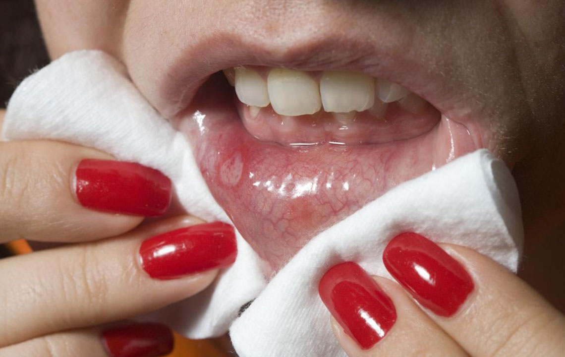 Effective ways to prevent cold sores