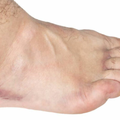 Exercises for swollen ankles treatment