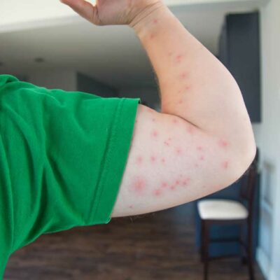 How to Identify and Treat Bedbug Bites