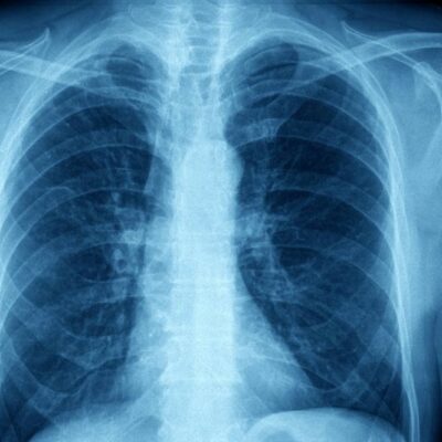 Pathology and Pathophysiology of Asthma