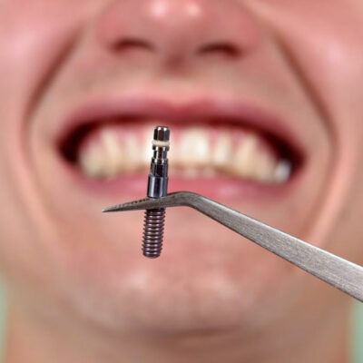 Things you should know about dental implants costs