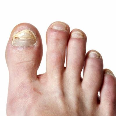 Top signs of toe nail fungus