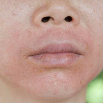 Treatment Methods for Lupus Skin Rashes