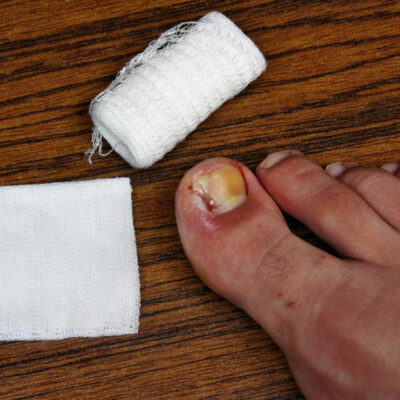 Ways to Treat Toe Nail Fungus During Pregnancy