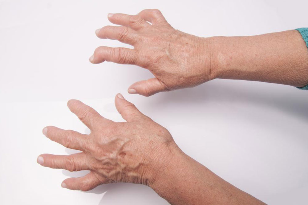 What you need to know about Rheumatoid Arthritis and Lupus