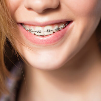 4 common types of teeth braces for adults