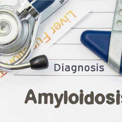 5 natural treatment options for amyloidosis