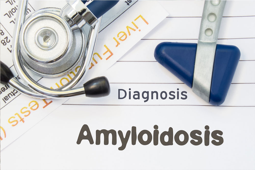 5 natural treatment options for amyloidosis