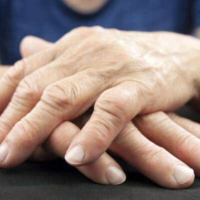 6 Ways to Manage the Symptoms of Arthritis