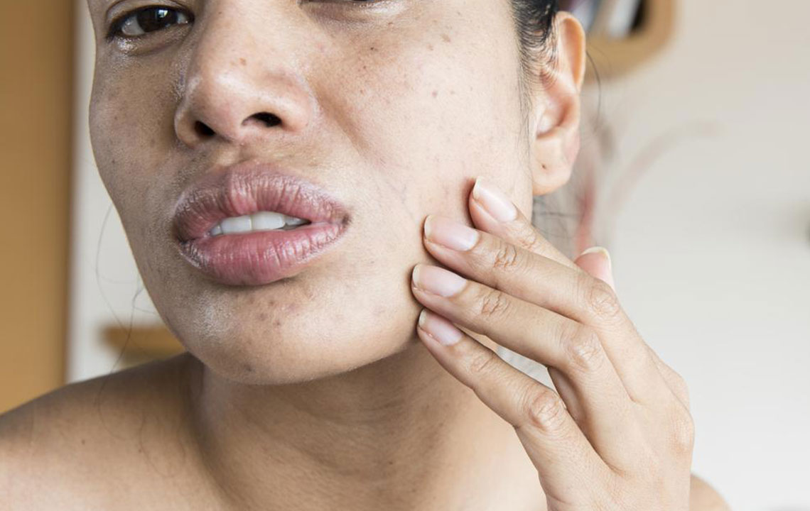 9 Symptoms of Lupus Women Should Know About