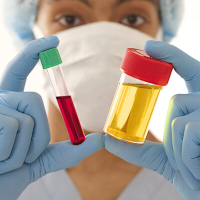 All You Need To Know About Blood In Urine