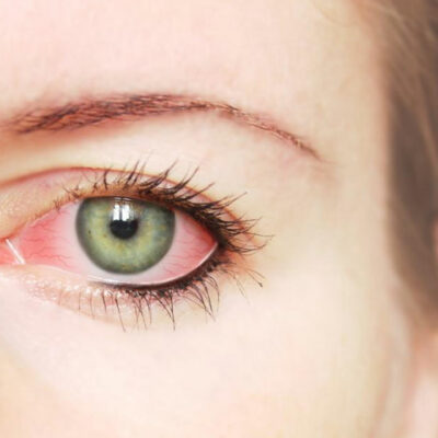 Common Causes and Treatments for Red Eye