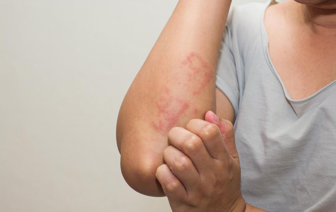 Dietary Changes and Tips to Cure Shingles Rash