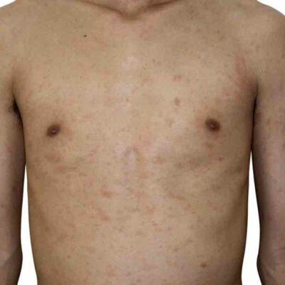 Different Types of Pityriasis Rosea Treatments