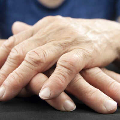 Easy Ways to Manage Psoriatic Arthritis