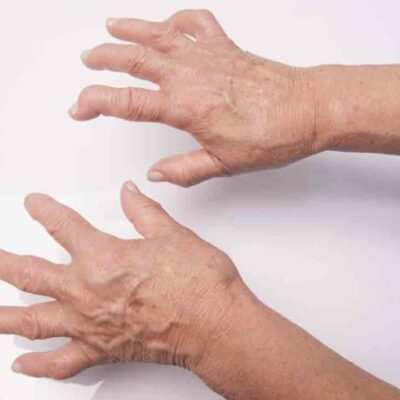 Food Items You Should Avoid When Suffering from Arthritis