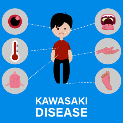 Kawasaki disease &#8211; causes and symptoms