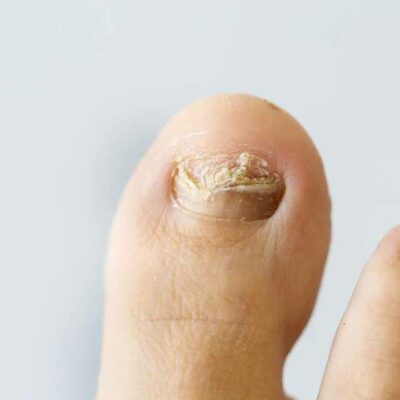 Some tips on how to cure nail fungus