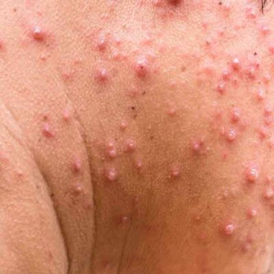 Tips to Treat Shingles Rash