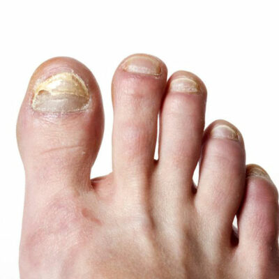 Tried and Tested Natural Cure for Toenail Fungus