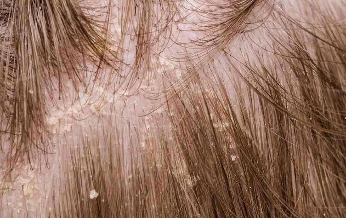 Useful Mild Treatment Solutions for Scalp Psoriasis Problem