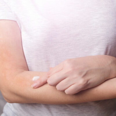 Itchy Skin &#8211; Best Anti-Itch Creams and Home Remedies