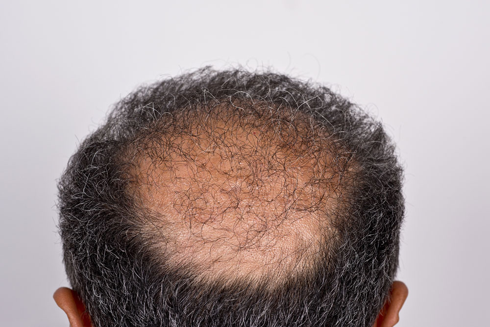 Hair Transplant &#8211; Types, Procedure, and Cost