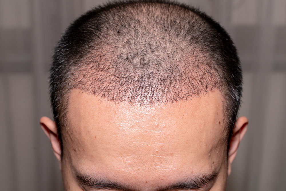 Hair Transplant &#8211; Types, Benefits, and Tips to Choose a Doctor